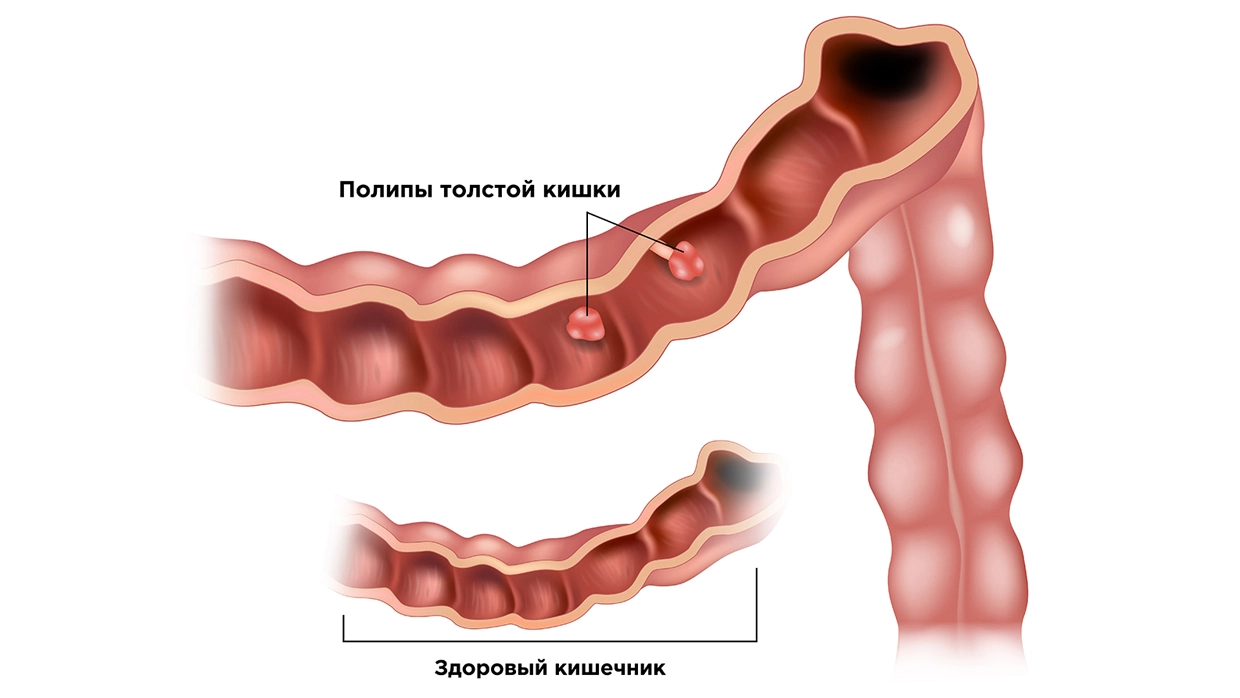 Удаление полипов в кишечнике и желудке по полису ОМС